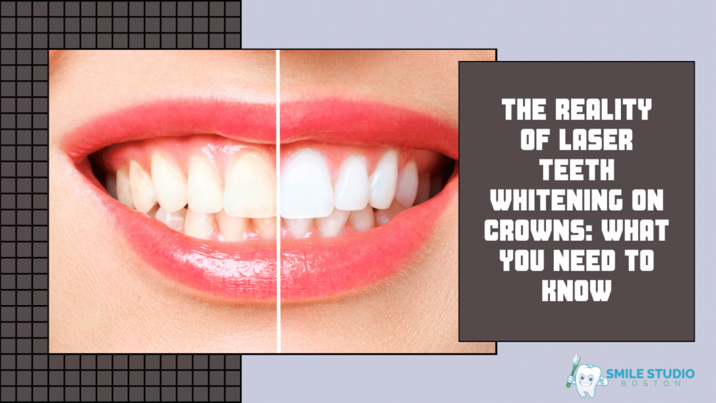 The Reality of Laser Teeth Whitening on Crowns: What You Need to Know