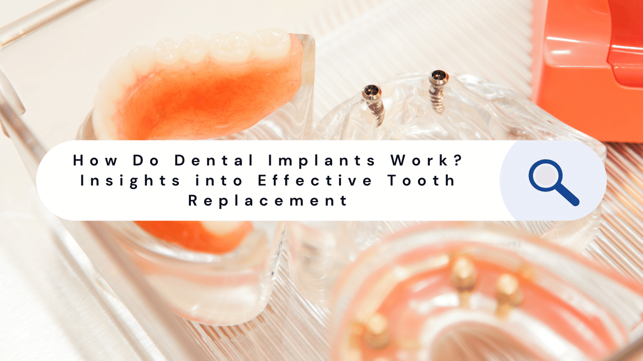 How Do Dental Implants Work? Insights into Effective Tooth Replacement