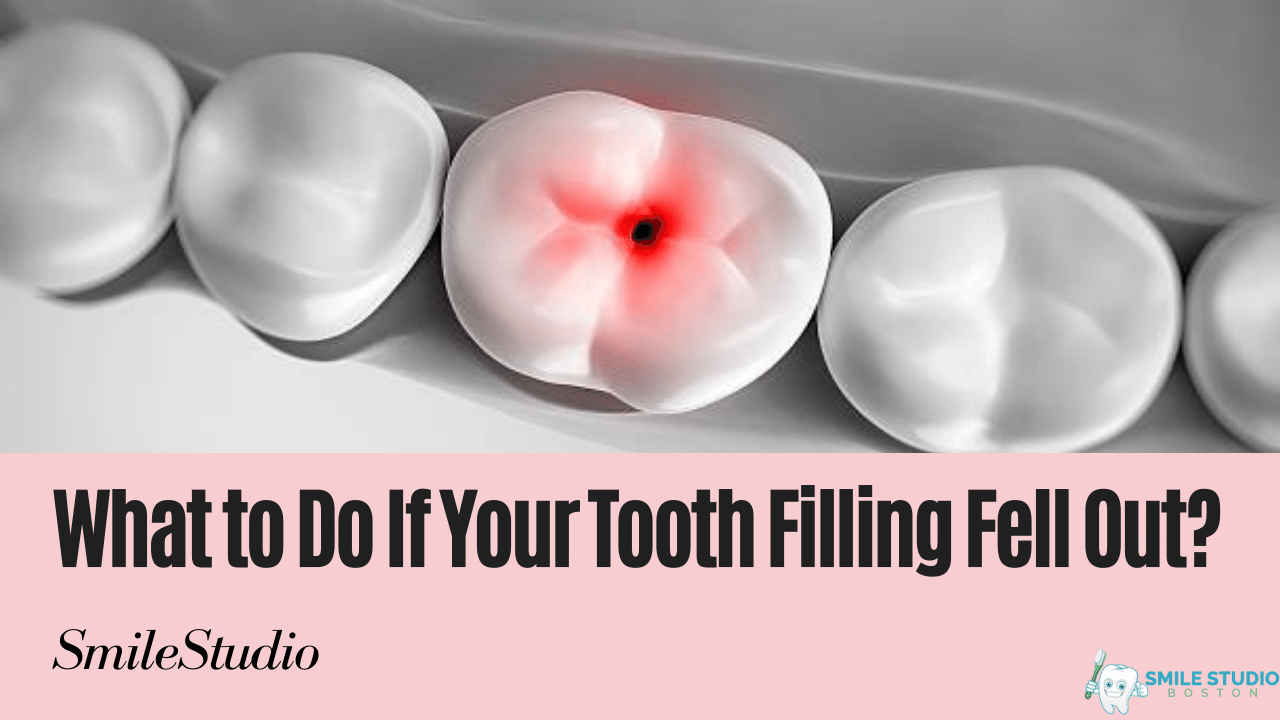 What to Do If Your Tooth Filling Fell Out?