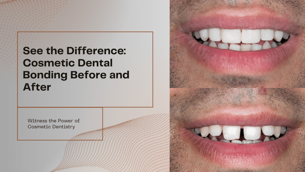 See the Difference: Cosmetic Dental Bonding Before and After Photos