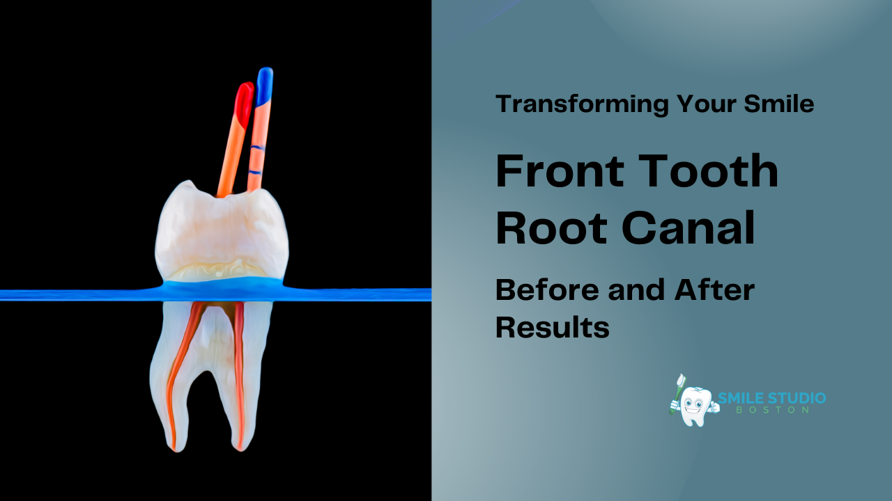 Transforming Your Smile: Front Tooth Root Canal Before and After Results