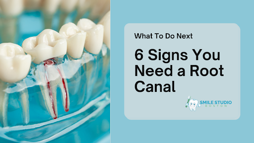 6 Signs You Need a Root Canal and What to Do Next
