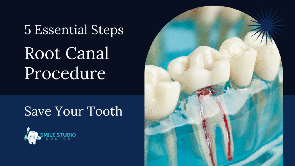 Root Canal Procedure: 5 Essential Steps to Save Your Tooth
