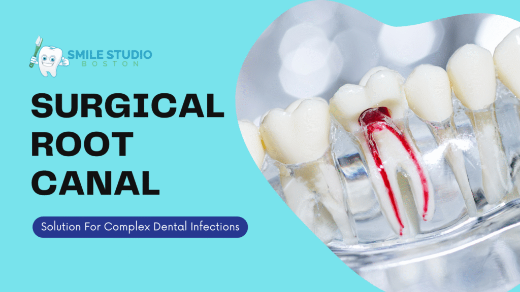 Surgical Root Canal: A Solution for Complex Dental Infections