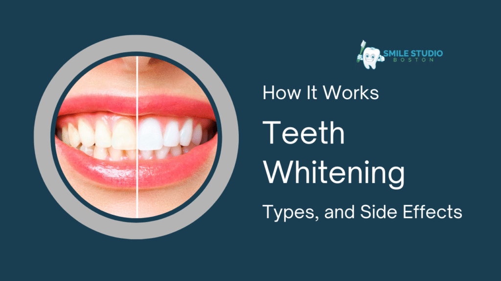Teeth Whitening: How It Works, Types, and Side Effects
