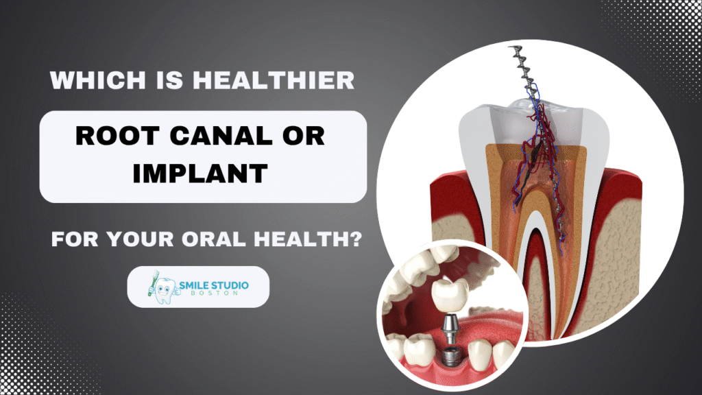 Which Is Healthier: Root Canal or Implant for Your Oral Health?