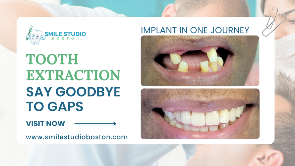 Say Goodbye to Gaps: Tooth Extraction and Implant in One Journey